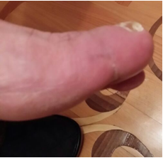 Stopa cukrzycowa - Testimonial photo