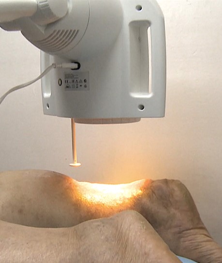 Terapia Bioptron Hyperlight w leczeniu owrzodzenia stopy cukrzycowej - Testimonial photo