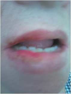 Uraz spowodowany oparzeniem - Testimonial photo