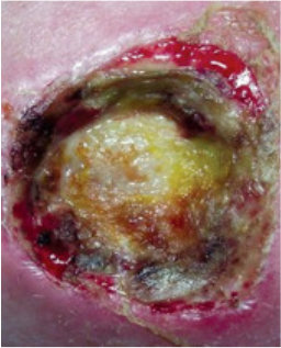 4° pressure ulcer of the greater trochanter area on the day of admission