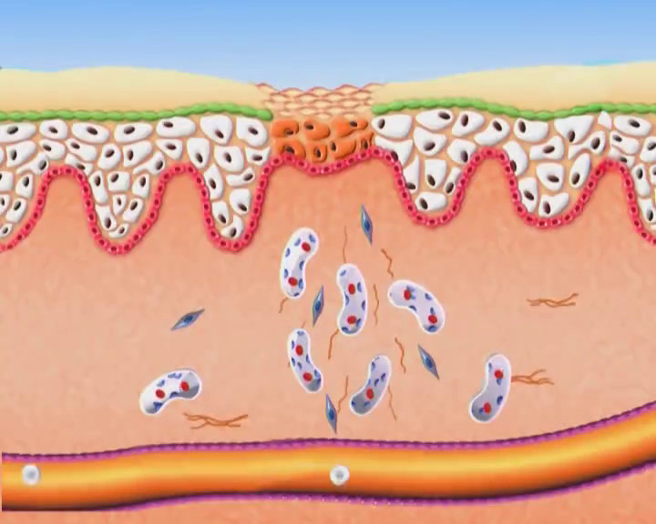 Video Poster - Terapia światłem BIOPTRON<sup>®</sup> w leczeniu ran